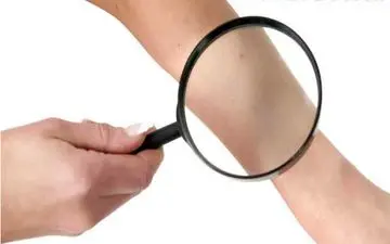 روش های چکاپ سرطان پوست