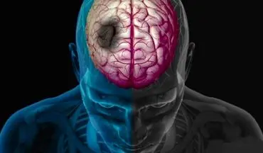  سکته مغزی در ساعات اولیه قابل درمان است 