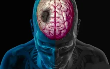  سکته مغزی در ساعات اولیه قابل درمان است 