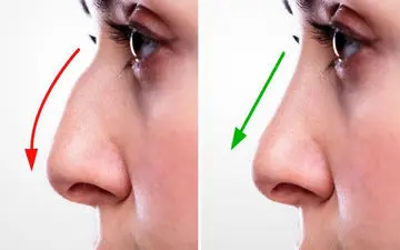 بهترین کاندید برای جراحی زیبایی بینی با روش باز