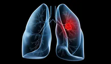 سرطان ریه: علائم اولیه و درمان‌های نوین