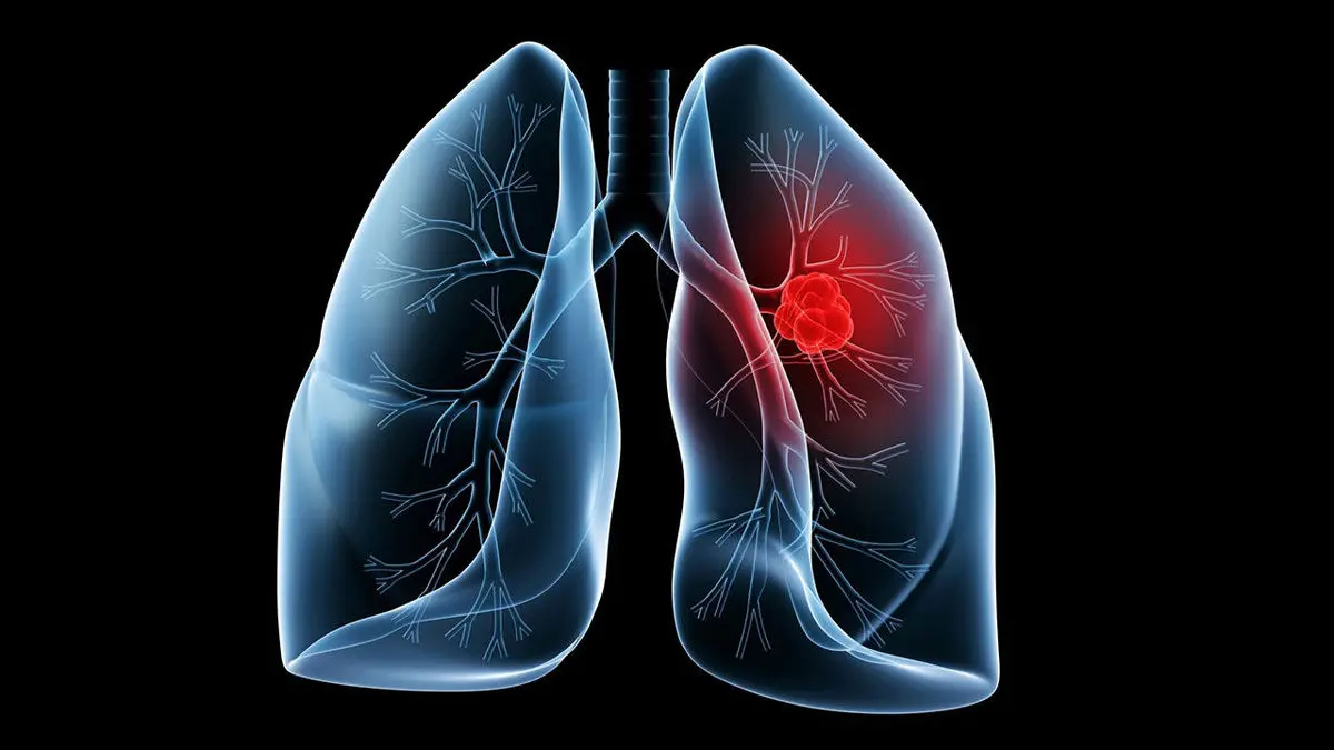 سرطان ریه: علائم اولیه و درمان‌های نوین