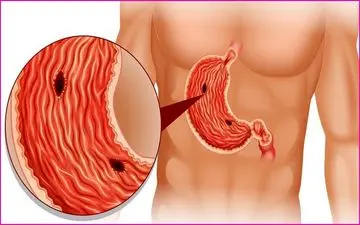 چگونه از مشکلات گوارشی در ماه رمضان جلوگیری کنیم؟