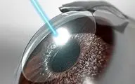 مراقبت‌هایی که پس از جراحی لیزیک چشم الزامی است