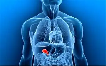 سنگ کیسه صفرا در کمین چاق‌ها!