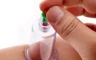  حجامت زیر چانه چیست؟حجامت برای این افراد ممنوع!