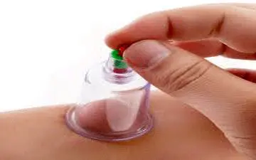  حجامت زیر چانه چیست؟حجامت برای این افراد ممنوع!