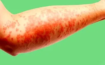  تأثیر مستقیم اضطراب بر تشدید بیماری اگزما 