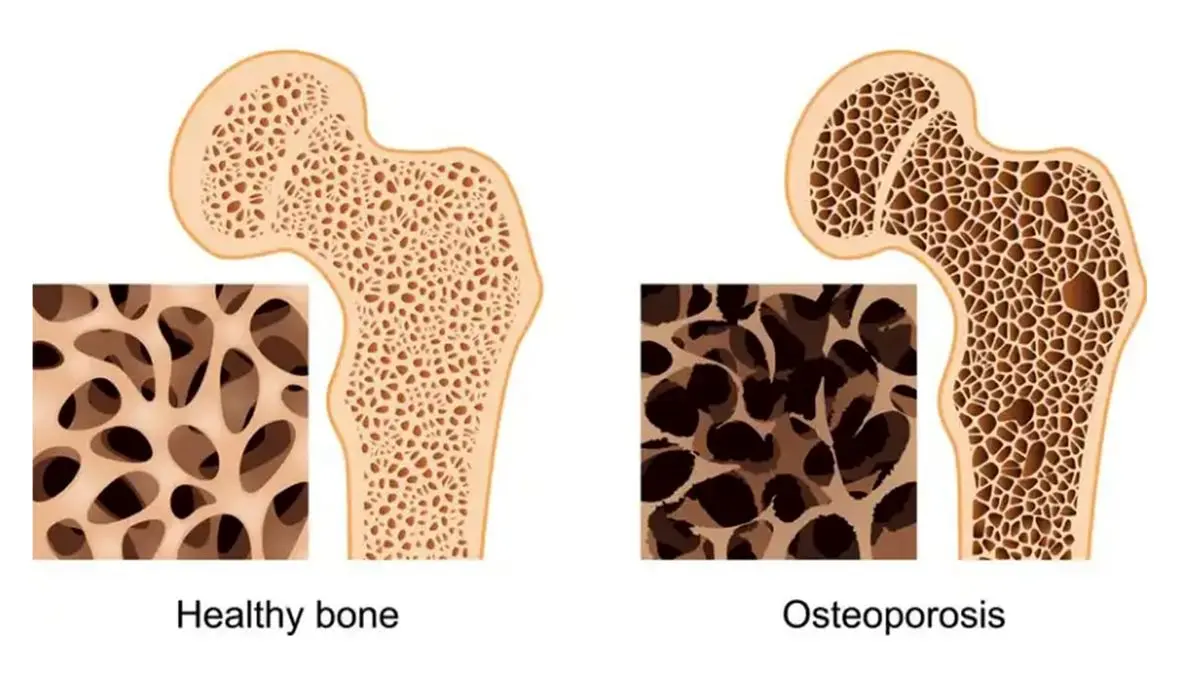 علائم اولیه و بسیار مهم پوکی استخوان!