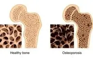 علائم اولیه و بسیار مهم پوکی استخوان!