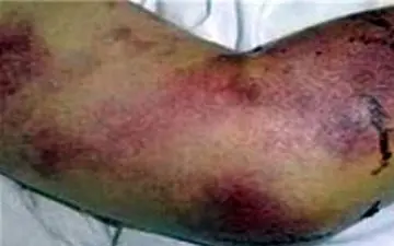 تب کریمه در کمین رستوران‌های بین راهی 