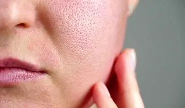 پوست حساس دارید؟ این مقاله را از دست ندهید! نکات طلایی برای مراقبت از پوست های حساس