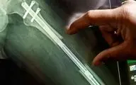 پشت پرده یک جراحی عجیب؛ چرا زنان میلیون‌ها تومان خرج می‌کنند تا قدشان کوتاه‌تر شود؟