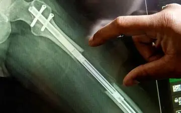 پشت پرده یک جراحی عجیب؛ چرا زنان میلیون‌ها تومان خرج می‌کنند تا قدشان کوتاه‌تر شود؟