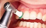 جرم‌گیری دندان: آسیب یا درمان؟ متخصص پاسخ می‌دهد