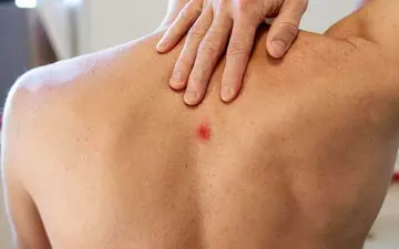 با جوش های کمر و پشت شانه ها چکار کنیم؟ بیا تا بهت بگم چکارشون کنی!