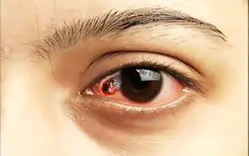 چشم‌هایتان را جدی بگیرید: هر آنچه باید درباره سرطان چشم بدانید
