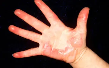 چگونه جای سوختگی بر روی پوست به وجود می‌آید؟