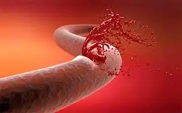 معجزه ای برای بند آوردن خونریزی!