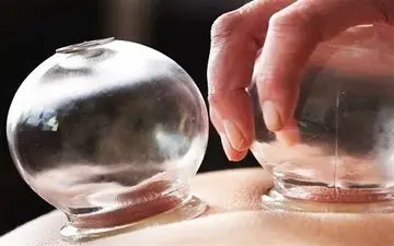 فواید مهم انجام "حجامت" بر سلامت بدن 