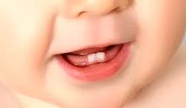 دندان شیری کودکان را دور نیندازید