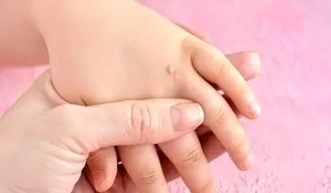 از علت تا درمان زگیل‌های دوران کودکی