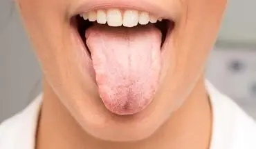علائم خشکی دهان چیست؟عوارض آن را بدانید!
