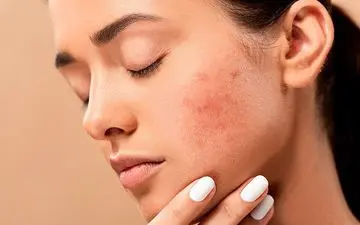 خودارضایی باعث آکنه می شود؟