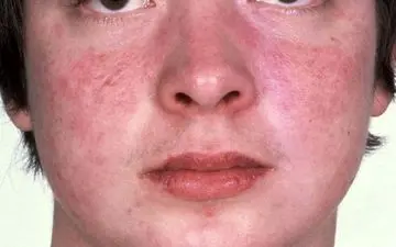 آلرژی به سیر چه علائمی دارد؟