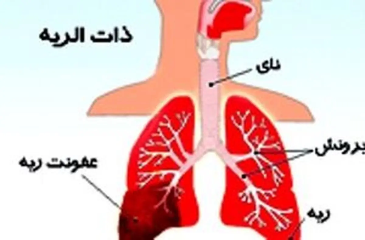  زنگ هشدار برای بیماری ذات الریه