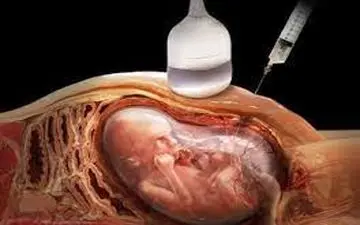 آیا غربالگری در دوران بارداری ضرورت دارد؟|آزمایش های دوران بارداری لازم است یا نه؟