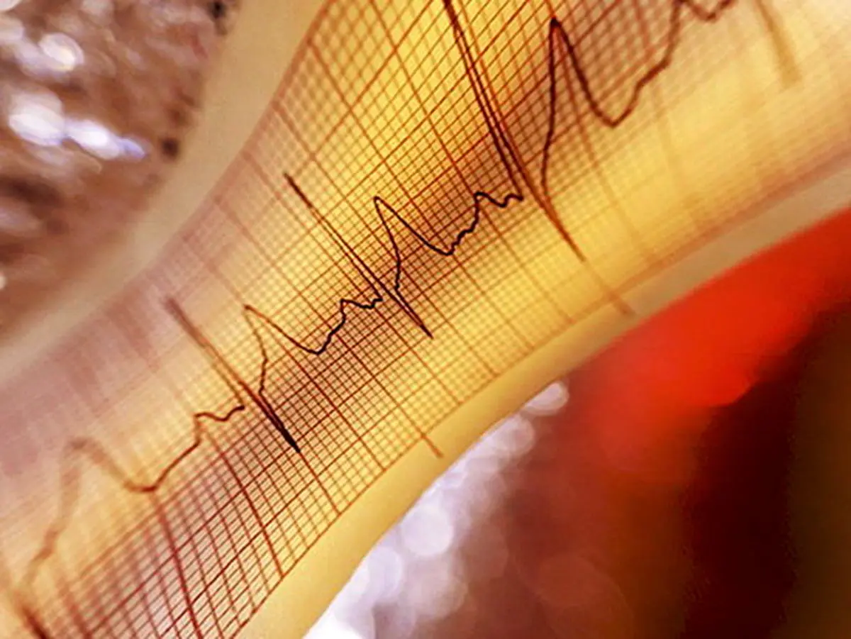  درصد سکته‌های مغزی ناشی از نامنظمی‌های ضربان قلب است