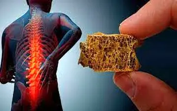 بهترین راهکار برای خلاصی از شر پوکی استخوان 