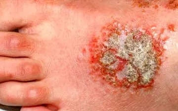 چه چیزی باعث تاول اگزما می شود؟


