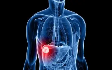 چگونه می شود خطر ابتلا به سرطان کبد را کاهش داد؟