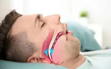 ارتباط آپنه خواب با صرع چیست؟