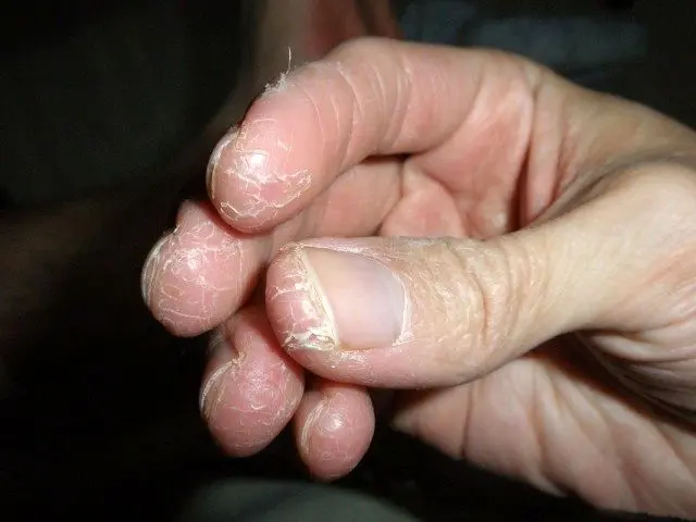 پوست پوست شدن انگشتان دست با مصرف مواد شیمیایی
