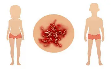 راه حلهای خانگی برای درمان تبخال دستگاه تناسلی