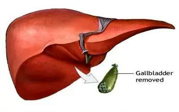 کیسه صفرا چیست و در بدن ما چه می‌کند؟ ‏