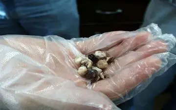 نشانه های سنگ کیسه صفرا