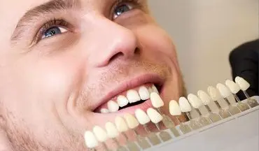 فرق لمینت و کامپوزیت دندان؛ کدومش واقعا بهتره؟
