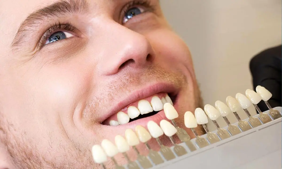 فرق لمینت و کامپوزیت دندان؛ کدومش واقعا بهتره؟