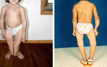 علائم نرمی استخوان چیست؟