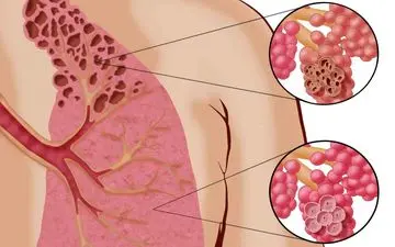 هشدار جدی| وسیله سرطان زا در آشپزخانه