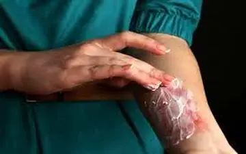 چند توصیه در مواجهه با سوختگی های سطحی!