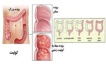 همه چیز درباره کولیت روده 