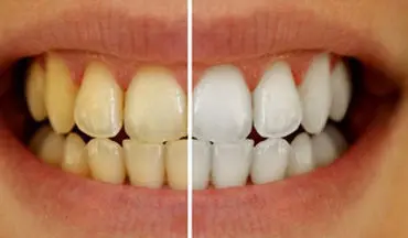  علل تغییر رنگ دندان ها+ راه درمان