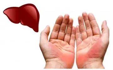 تغییرات کف دست نشانه چه بیماری است؟

