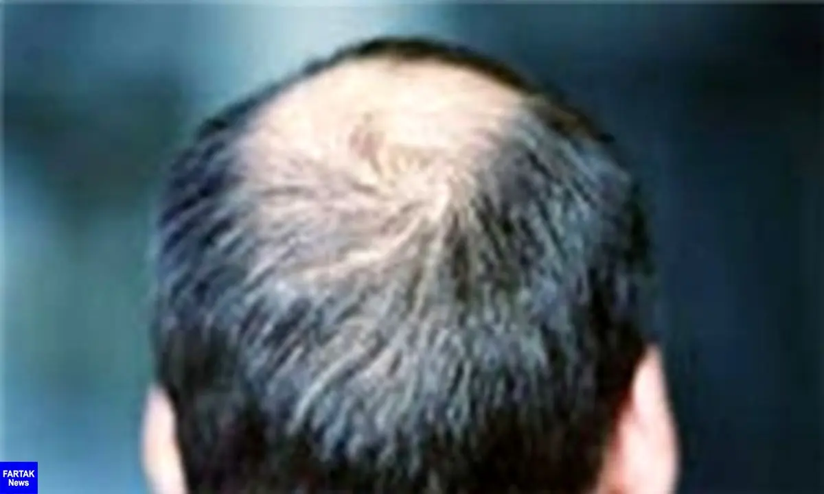 کاهش سن ریزش مو/ دلایلی که سبب کچلی می‌شود