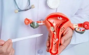 آیا اندومتریوز درمان نشده خطرناک است؟